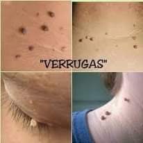 LÍQUIDO ELIMINA:  
  Hongos   Verrugas  mezquinos 
 lunares  de carne        ca