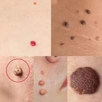 Facil y Rapido 
 ELIMINA y CAUTERIZA 
  mezquinos
 Verrugas 
 Lunares de carne