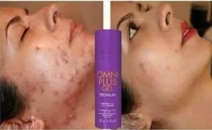 #OMNIPLUS_GEL_PREMIUM

Elimina el acné, secuelas, manchas y Quemaduras!! 

REGEN