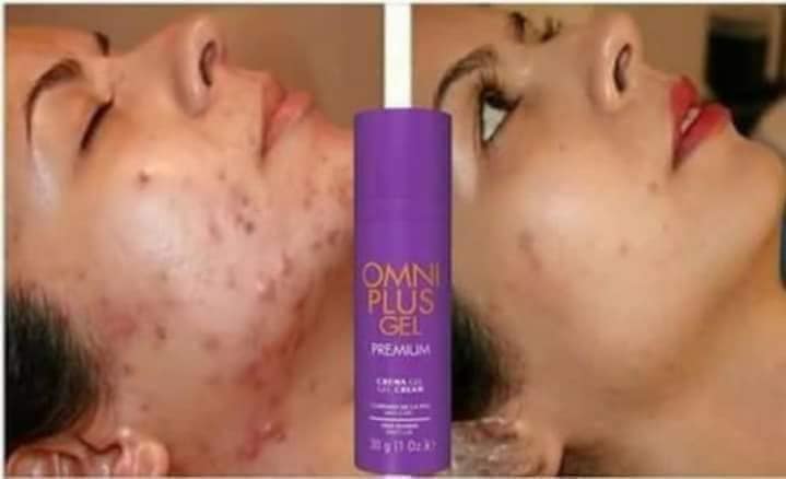 #OMNIPLUS_GEL_PREMIUM

Elimina el acné, secuelas, manchas y Quemaduras!! 

REGEN